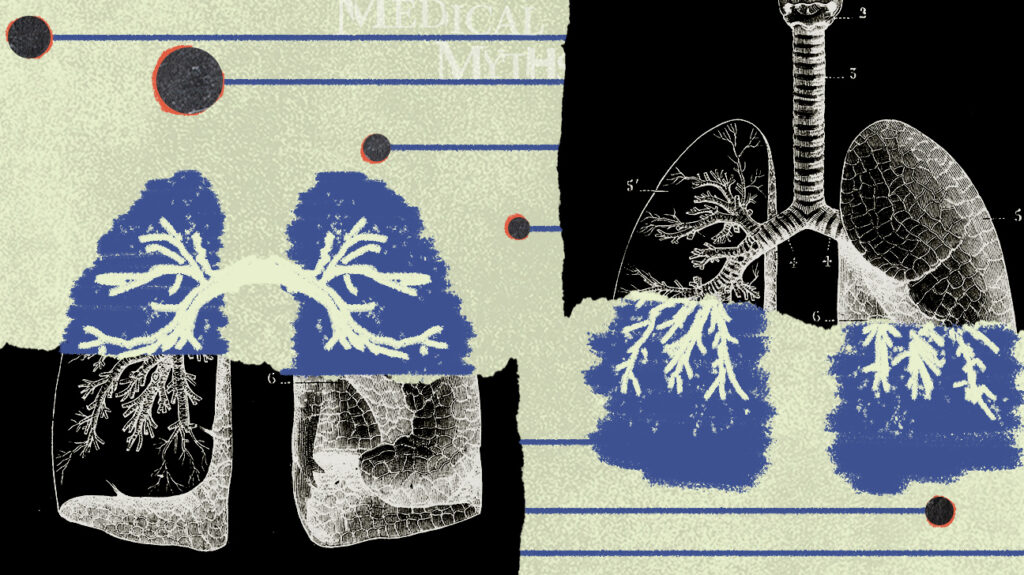mitos médicos sobre el cáncer de pulmón